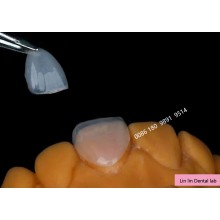 深圳義齒工廠 假牙廠家 認證定制式固定義齒產品