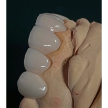 洛杉磯專業假牙技師 - 全口義齒 活動假牙