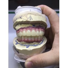 深圳種植牙外貿義齒公司 全口種植馬龍橋